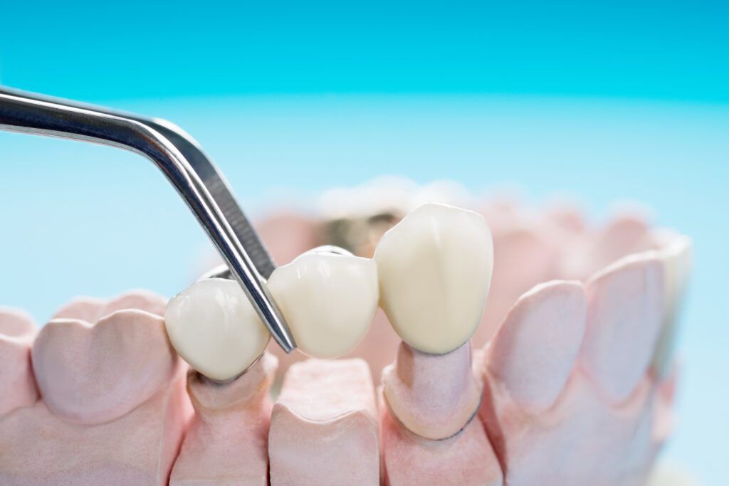 Tweezers placing a dental bridge in The Woodlands over a model of the teeth