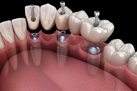 A graphic illustration of an implant bridge