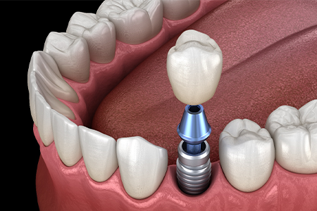 A graphic illustration of an implant crown