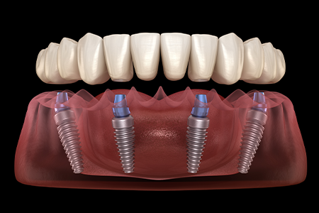 A graphic illustration of an implant denture