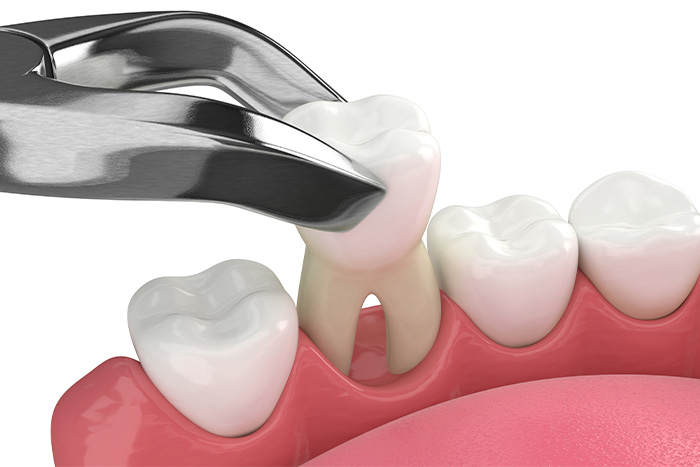 Illustration of dental forceps removing a tooth
