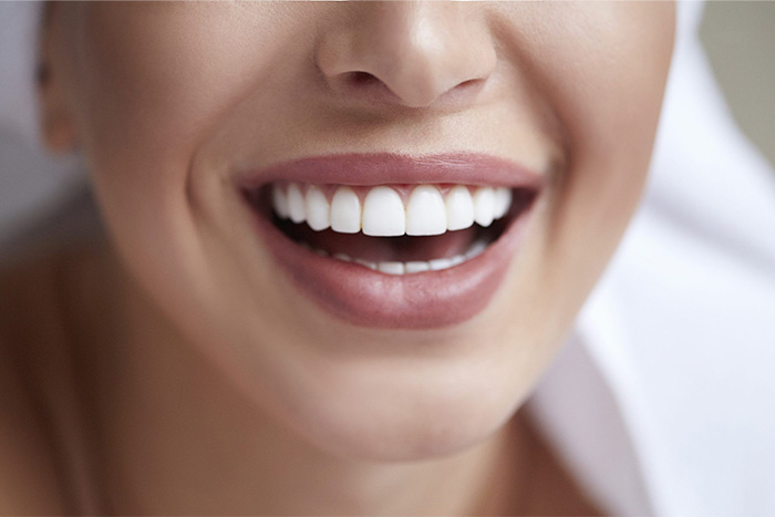 Close up of a flawless smile with dental veneers in The Woodlands.