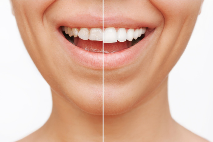 Patient's smile before and after veneers.