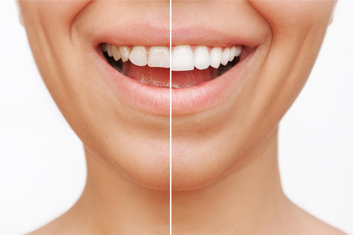 Patient's smile before and after smile makeover.