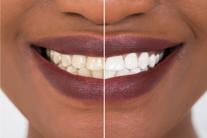 Patient's smile before and after teeth whitening.