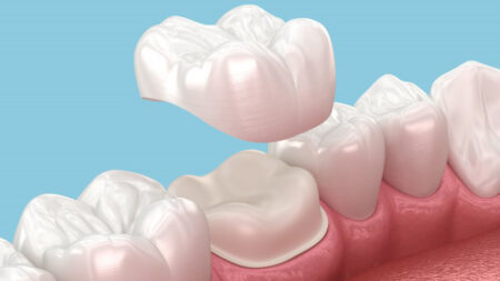 Digital image of a dental crown.