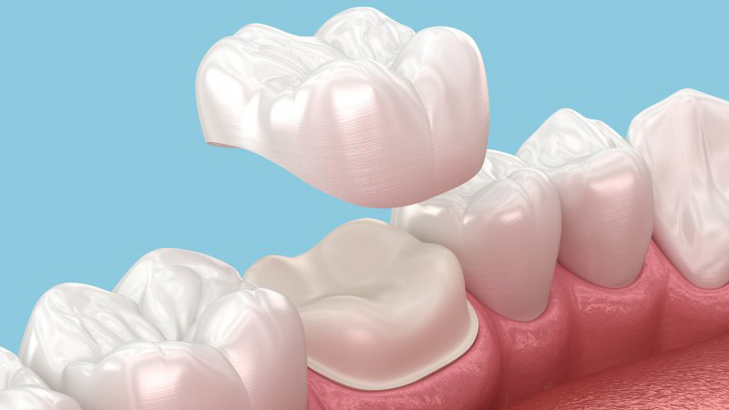 Digital image of a dental crown.