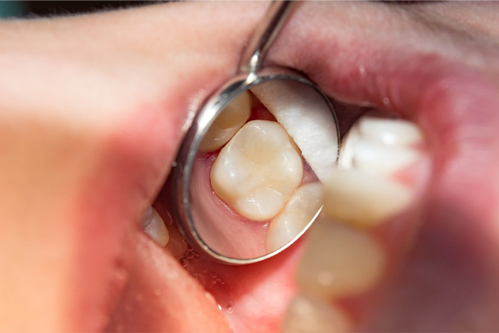Dental mirror showing dental filling.