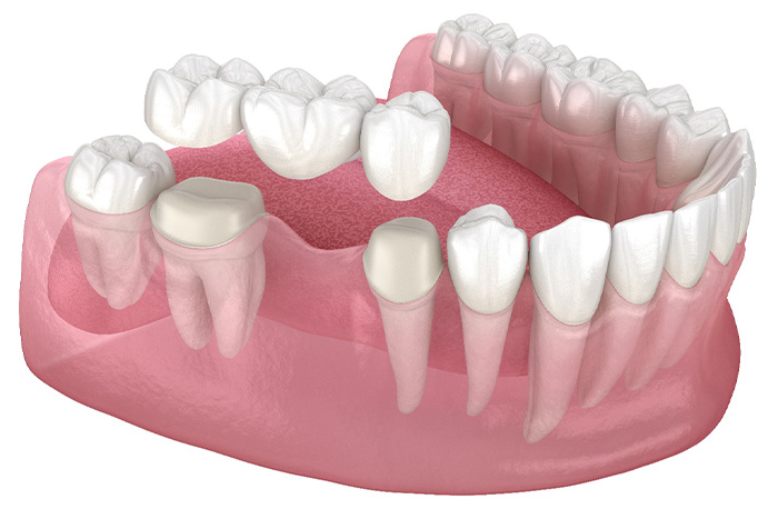 Illustration of a dental bridge.