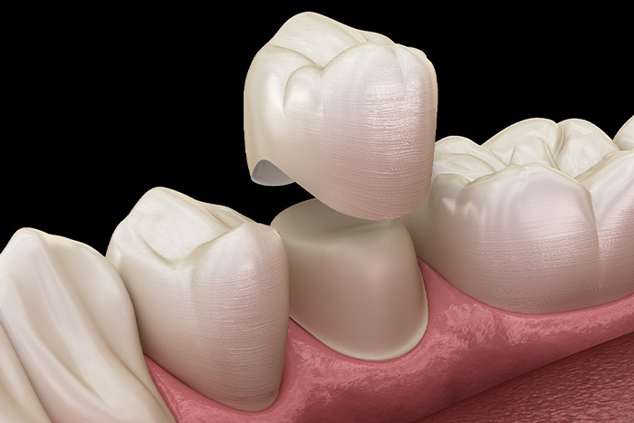Illustration of a dental crown.