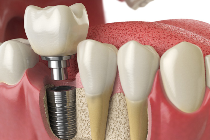 Illustration of a dental implant.